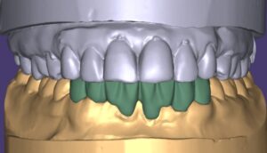 zirconia 1